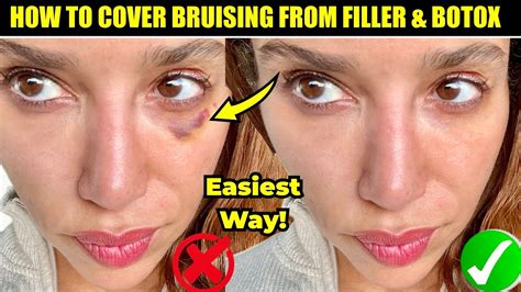 5 Ways to Reduce Bruising