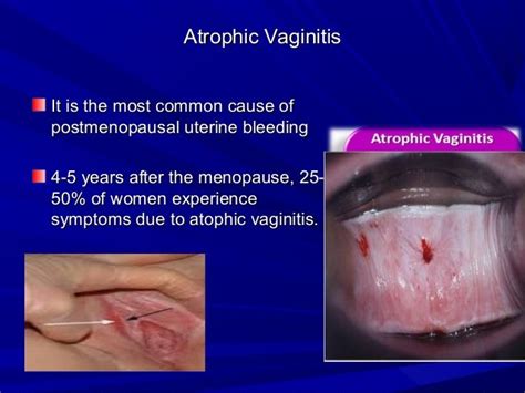 Atrophic Vulvovaginitis