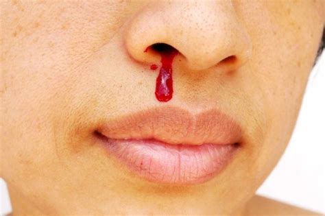 A person holding their nose due to a bloody nose