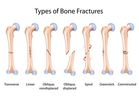 Description of Bone Fractures