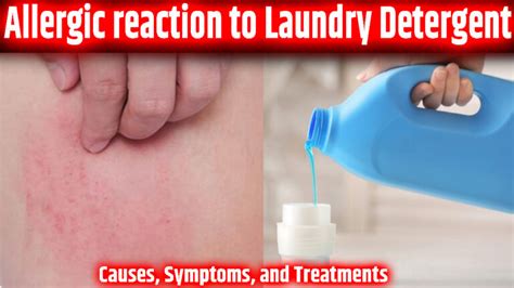 Causes of Laundry Soap Allergy Symptoms