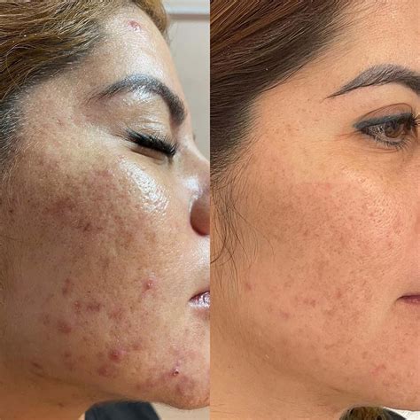 Chemical Skin Exfoliant Results Before After