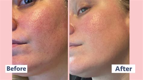 Chemical Skin Exfoliant Results