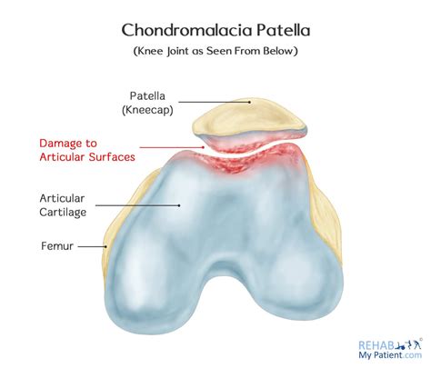 Chondrosis Condition