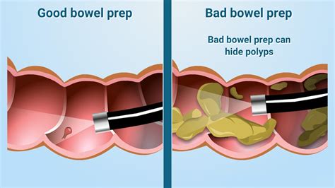 Colonoscopy Prep Image 7