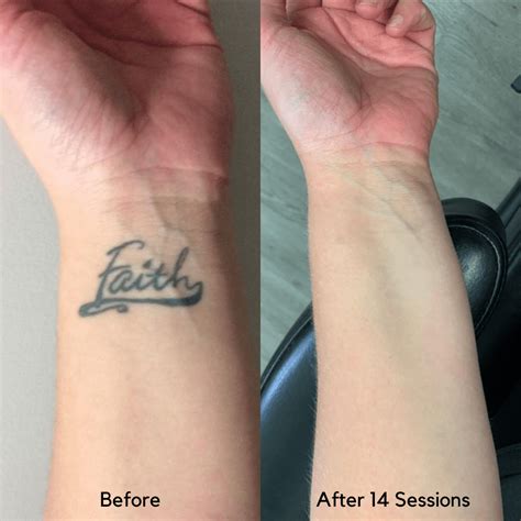 Colorful Wrist Tattoo Removal