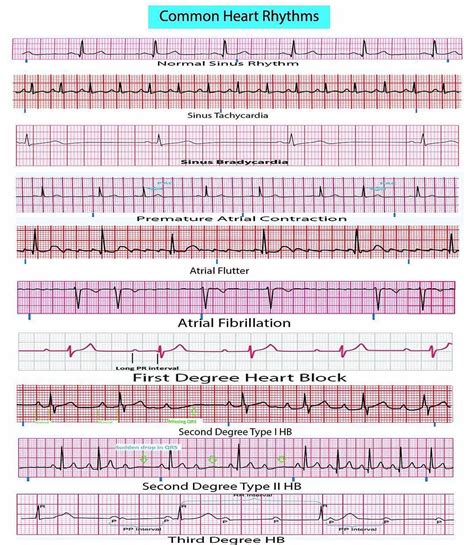 Cardiac Rhythms