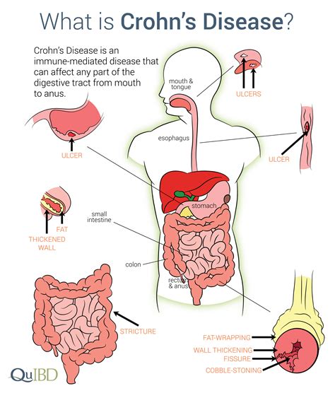 Crohn's Disease infographic