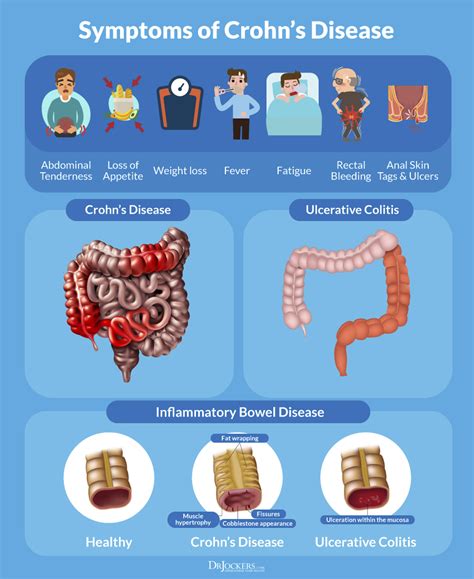 Crohn's Disease awareness