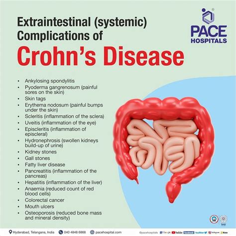 Crohn's Disease complications