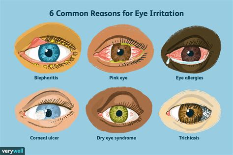 Dry Eyes and Irritation Causes and Symptoms