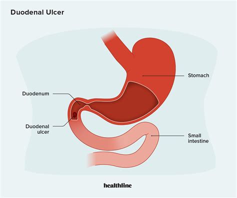 Duodenal Ulcer