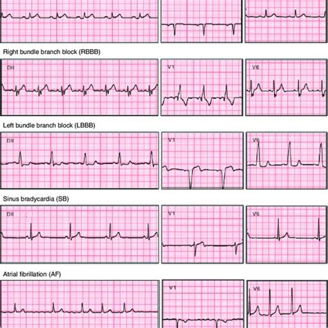 Common ECG Abnormalities