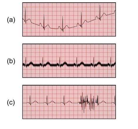 ECG Artifact Examples