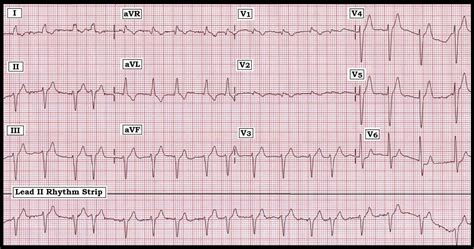 ECG Lead II Interpretation Example