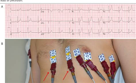 ECG Lead Placement Mistakes