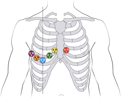 ECG Leads Placement