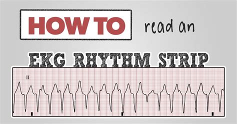 ECG Rhythm Strips