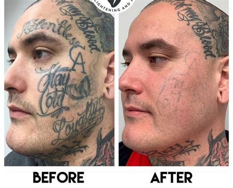 Face Tattoo Removal