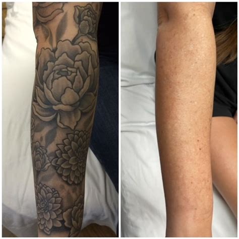 Forearm Tattoo Removal