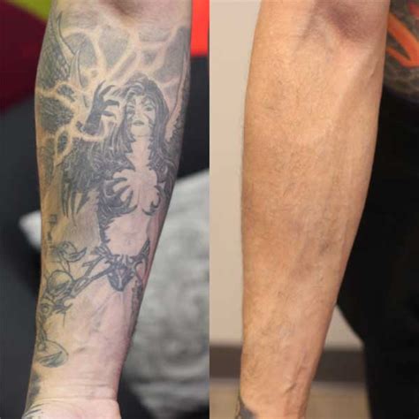 Forearm Tattoo Removal