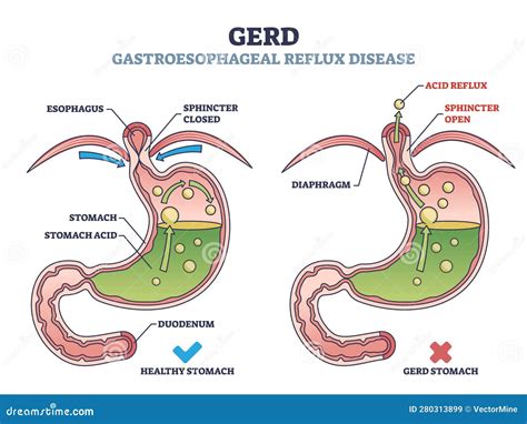 Gastroesophageal Reflux Disease