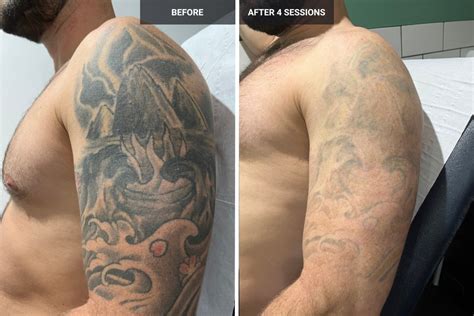 Laser tattoo removal in Tucson