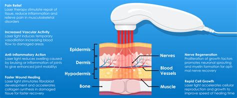 Laser Therapy Method for Wart Removal