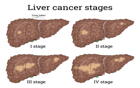 Liver Cancer