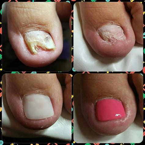 Nail Repair and Reconstruction