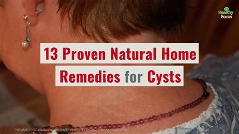 Natural Remedies for Cysts