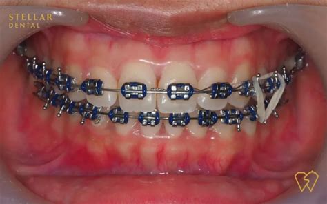 Navy Blue Braces and Self-Confidence