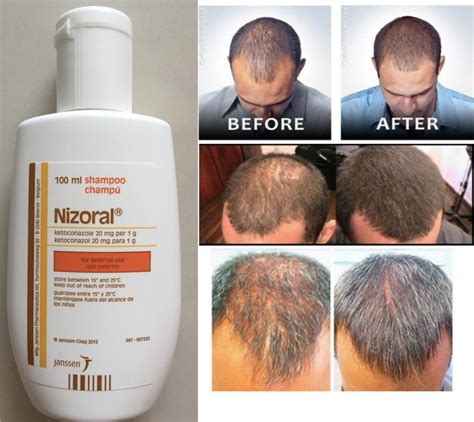 Nizoral For Hair Growth