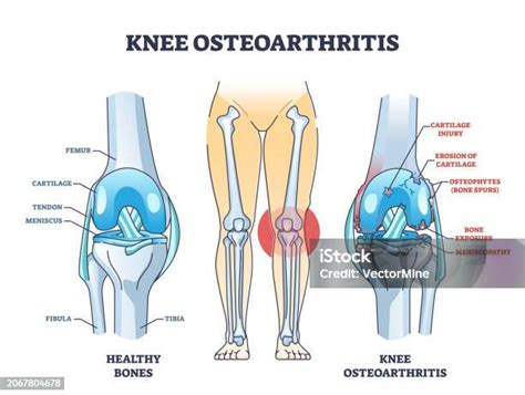 Osteoarthritis Condition