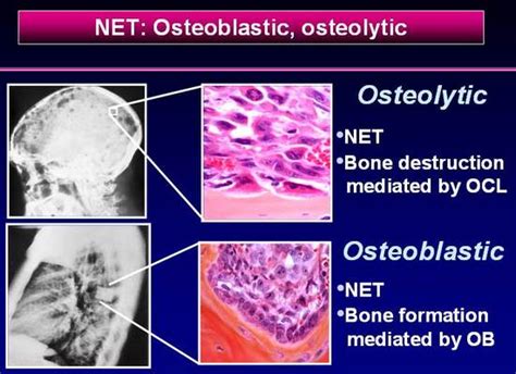 Description of Osteoblastic Lesions