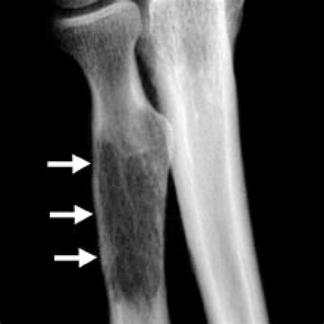 Description of Osteolytic Lesions