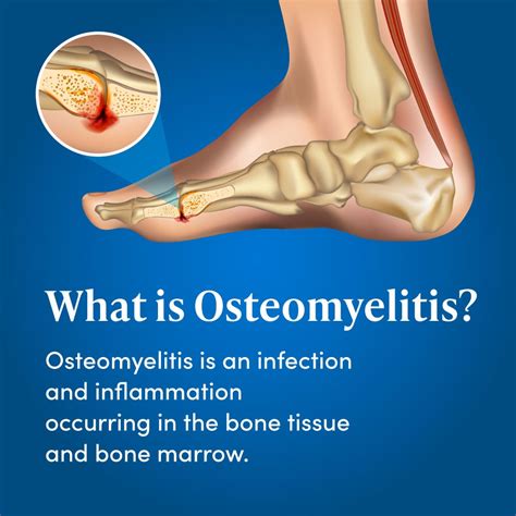 Description of Osteomyelitis