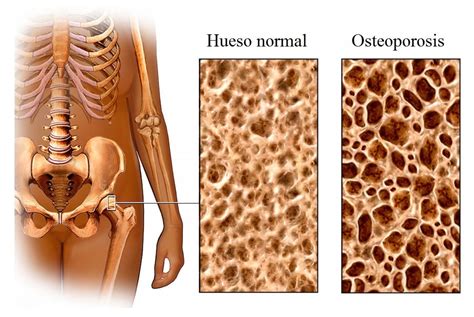 Osteoporosis