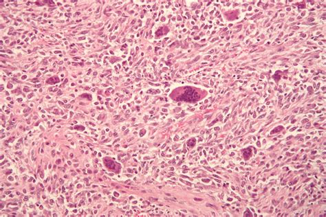 Description of Osteosarcoma