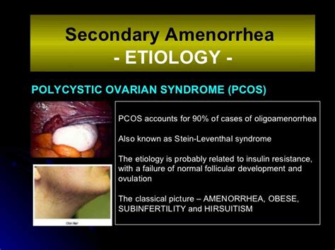 PCOS and Amenorrhea Symptoms