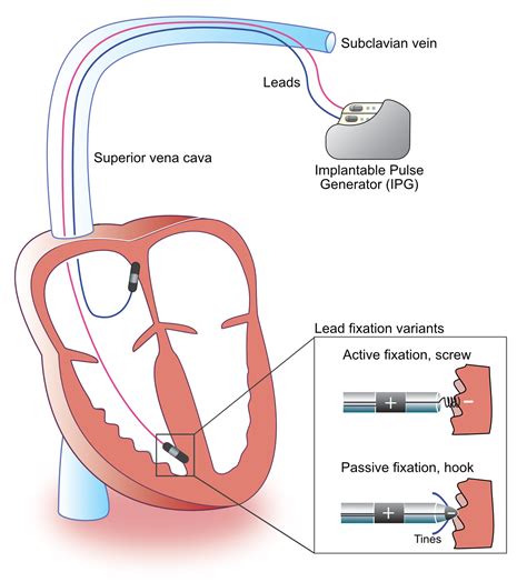 Features of St Jude Pacemaker MRI Compatible Device