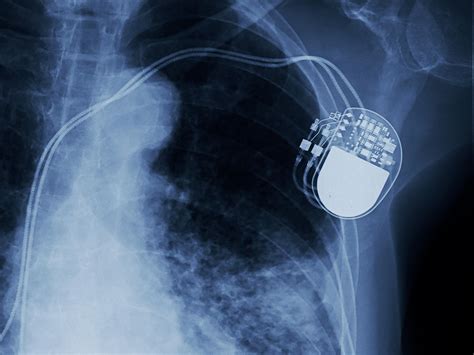 Pacemaker Implantation