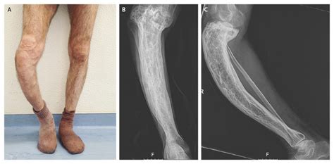 Paget Disease