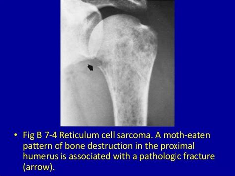 Prevention of Destructive Osseous Lesions