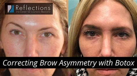 Professional Treatments for Fixing Uneven Eyebrows