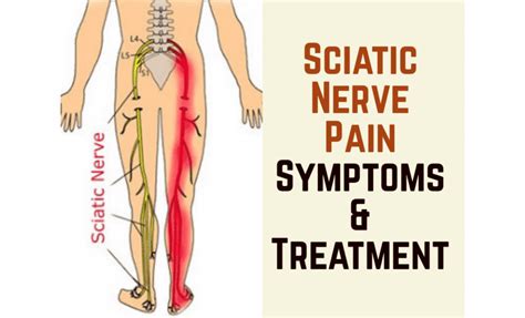 Sciatic Nerve Pain Relief Massage