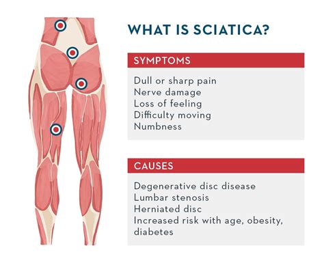 Sciatica Pain Causes