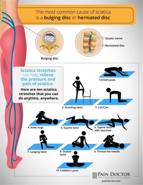 Sciatica Treatment and Recovery