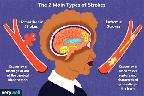 A diagram of the pathophysiology of stroke