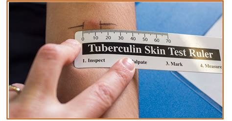 TB skin test ruler printable image 4